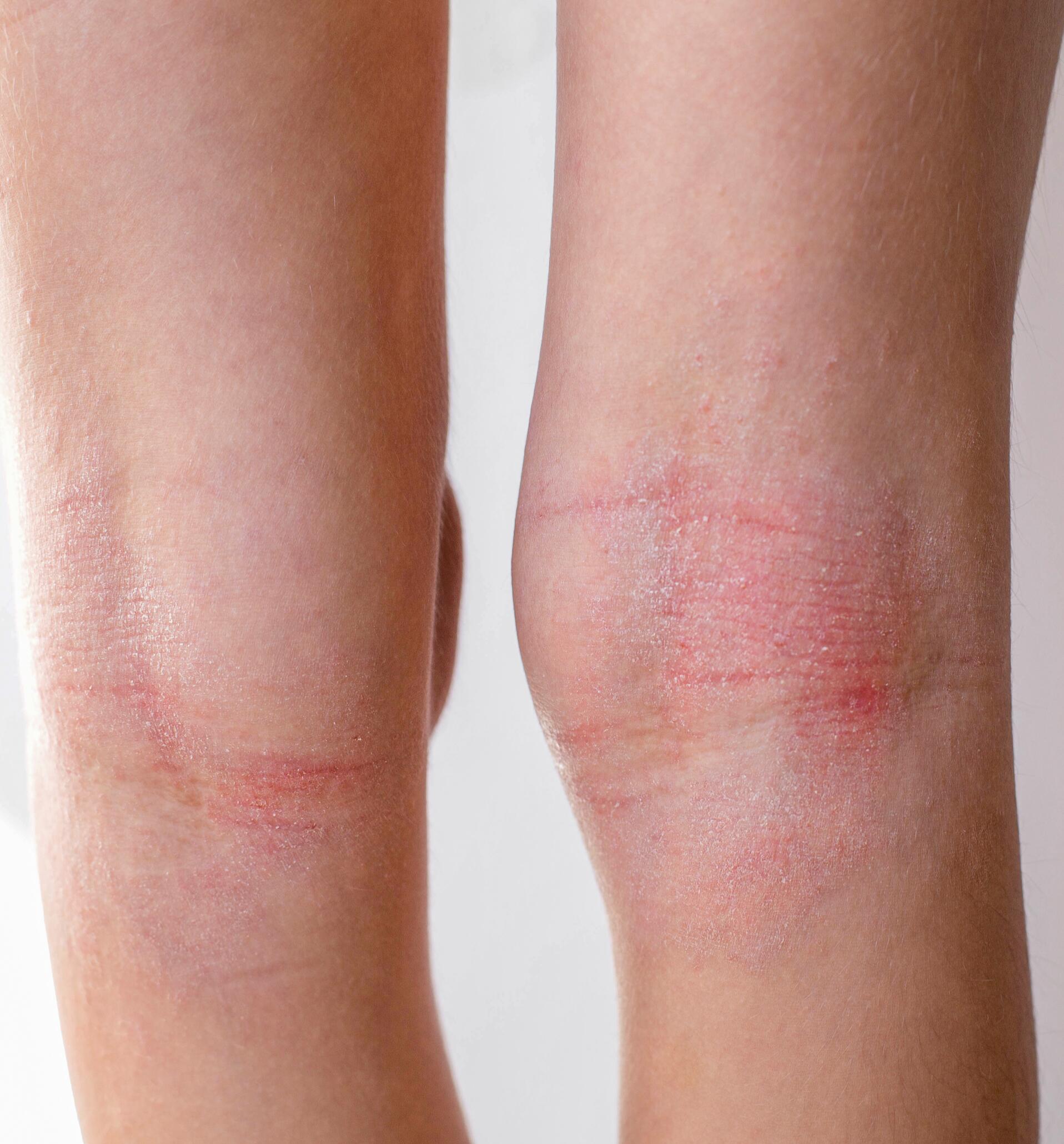 Symptoms of leg eczema